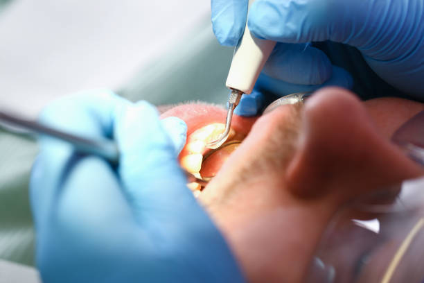 Best Emergency Dentist for Lost Fillings or Crowns in Crawfordsville, IN